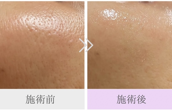 毛穴・くすみ・肌のゆるみが気になる方へ　那須塩原市のたるみ・シワ専門サロン、Wellging(ウェルジング)にお任せください！
