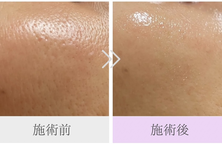 毛穴・くすみ・肌のゆるみが気になる方へ　那須塩原市のたるみ・シワ専門サロン、Wellging(ウェルジング)にお任せください！